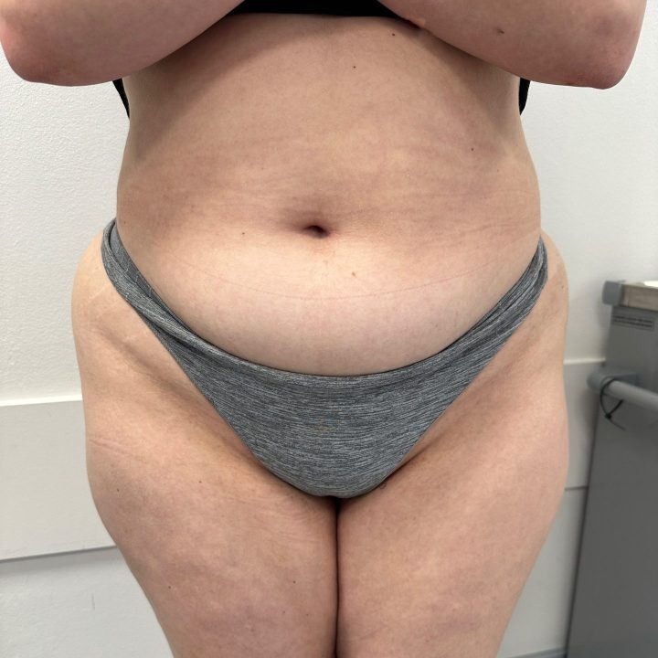 Liposuction before