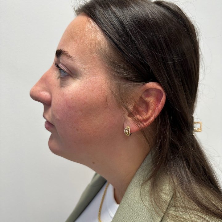 Eyelid correction after