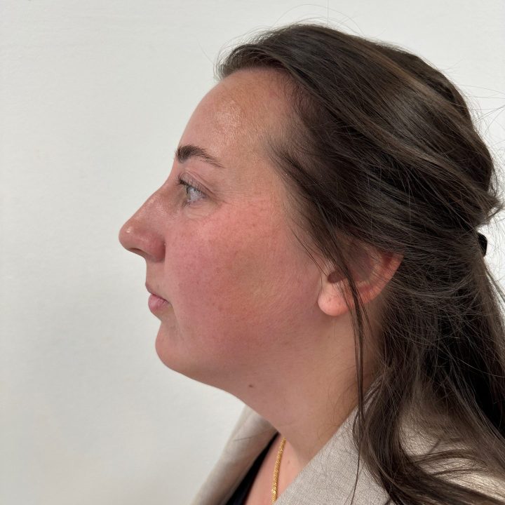Eyelid correction before
