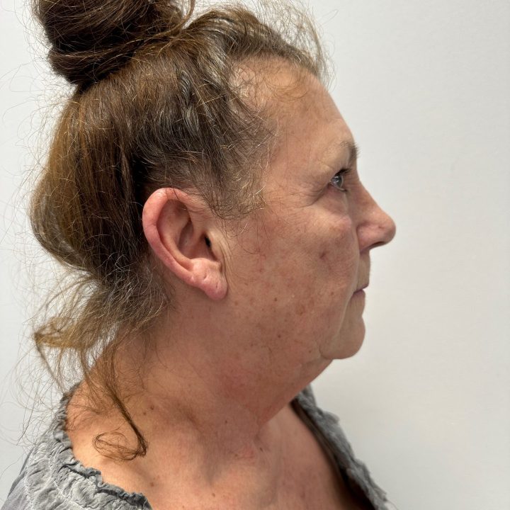 Eyelid correction after