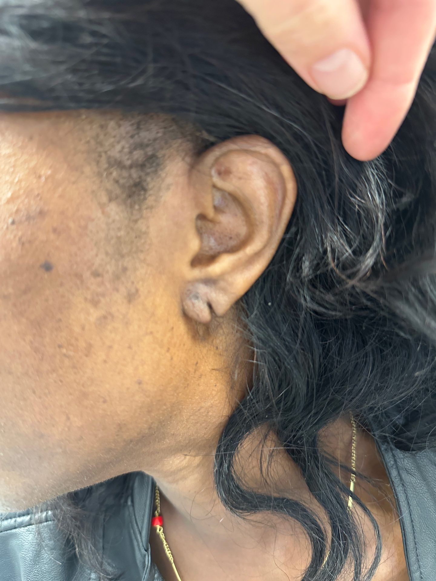 Earlobe correction before