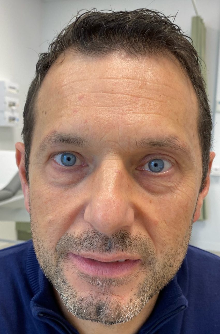Eyebrow lift after