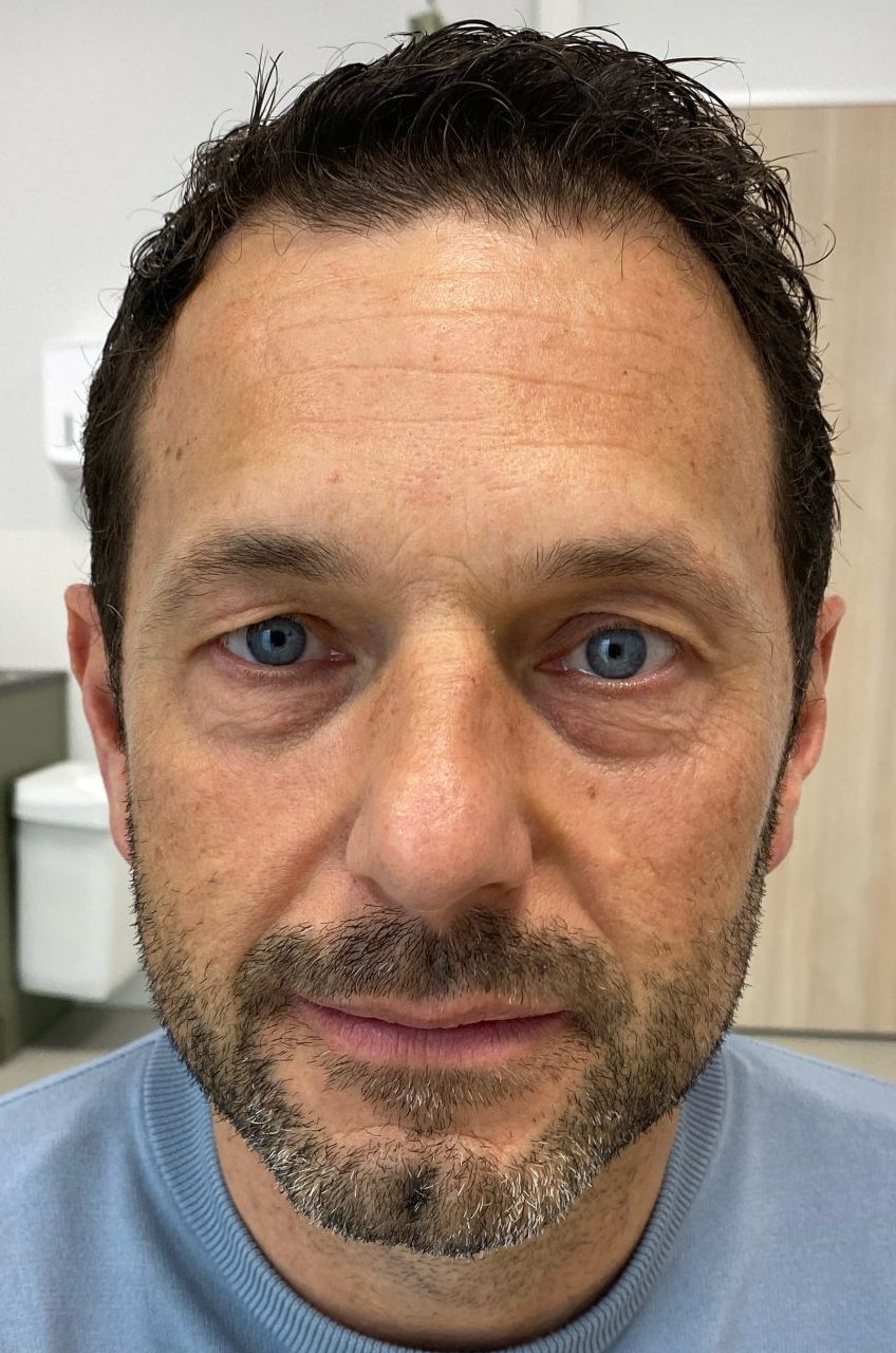 Eyebrow lift before