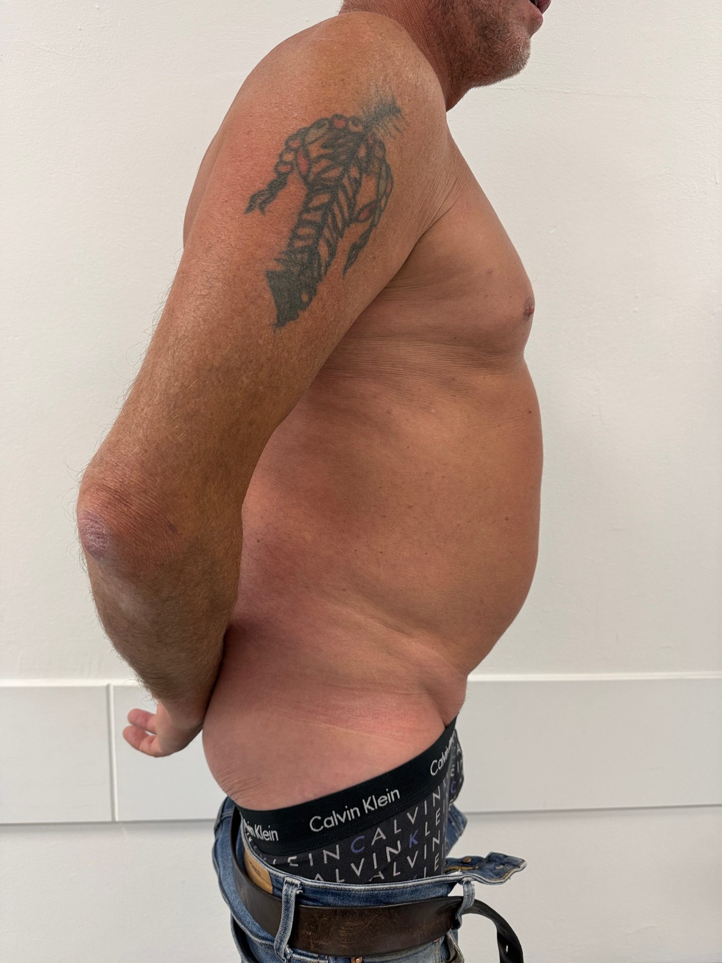 Liposuction before
