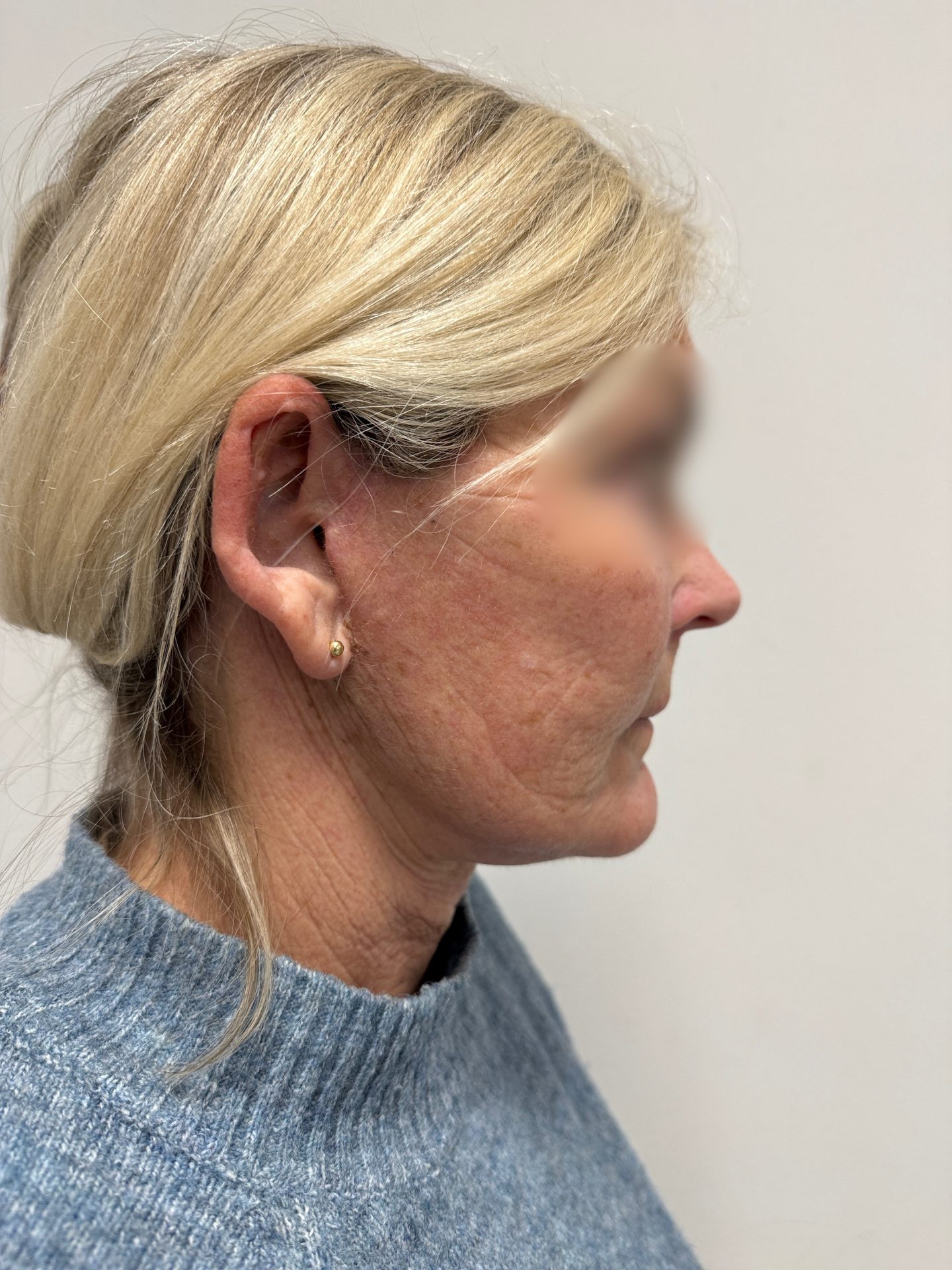Neck facelift after