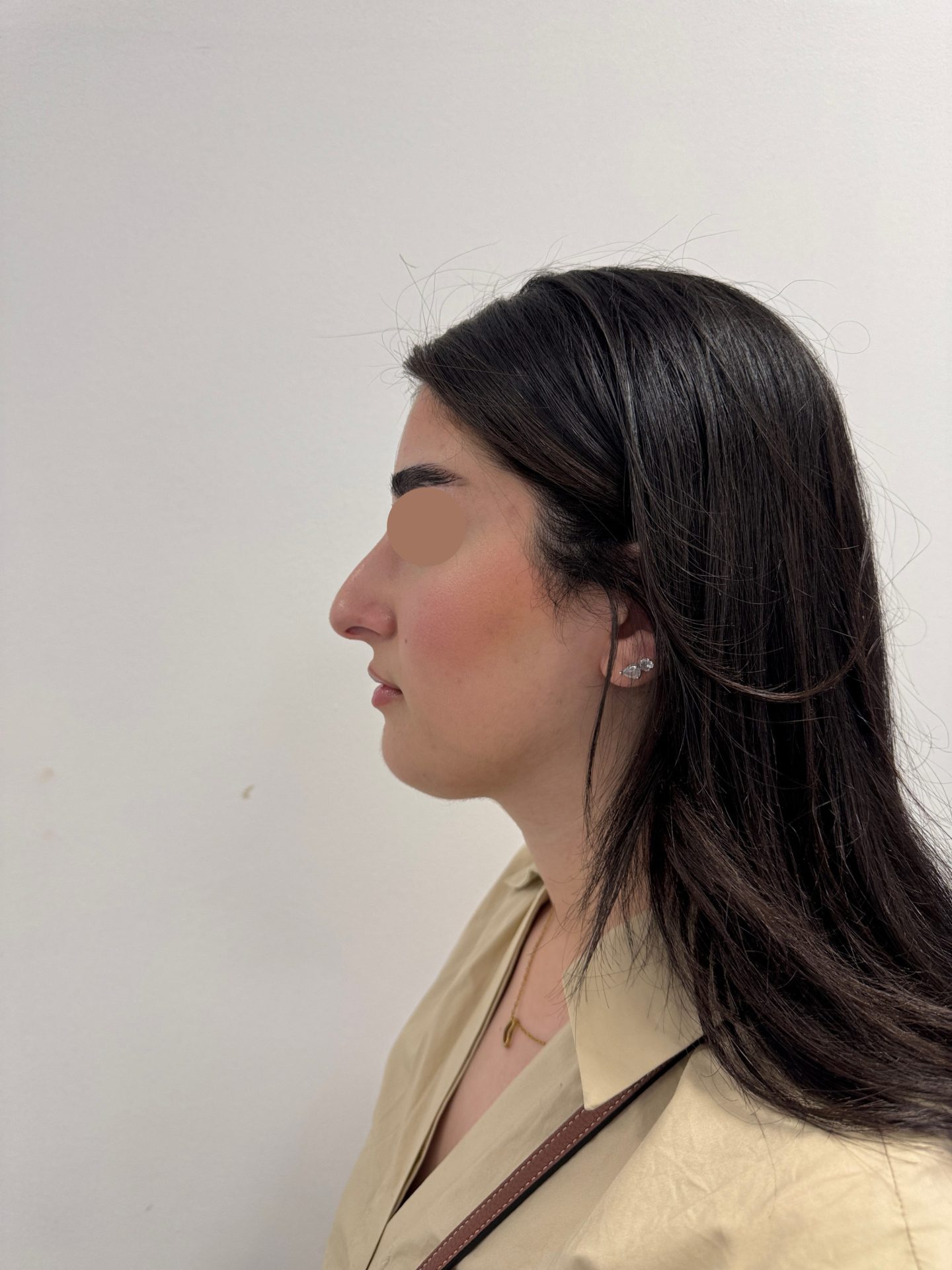 Nose correction before
