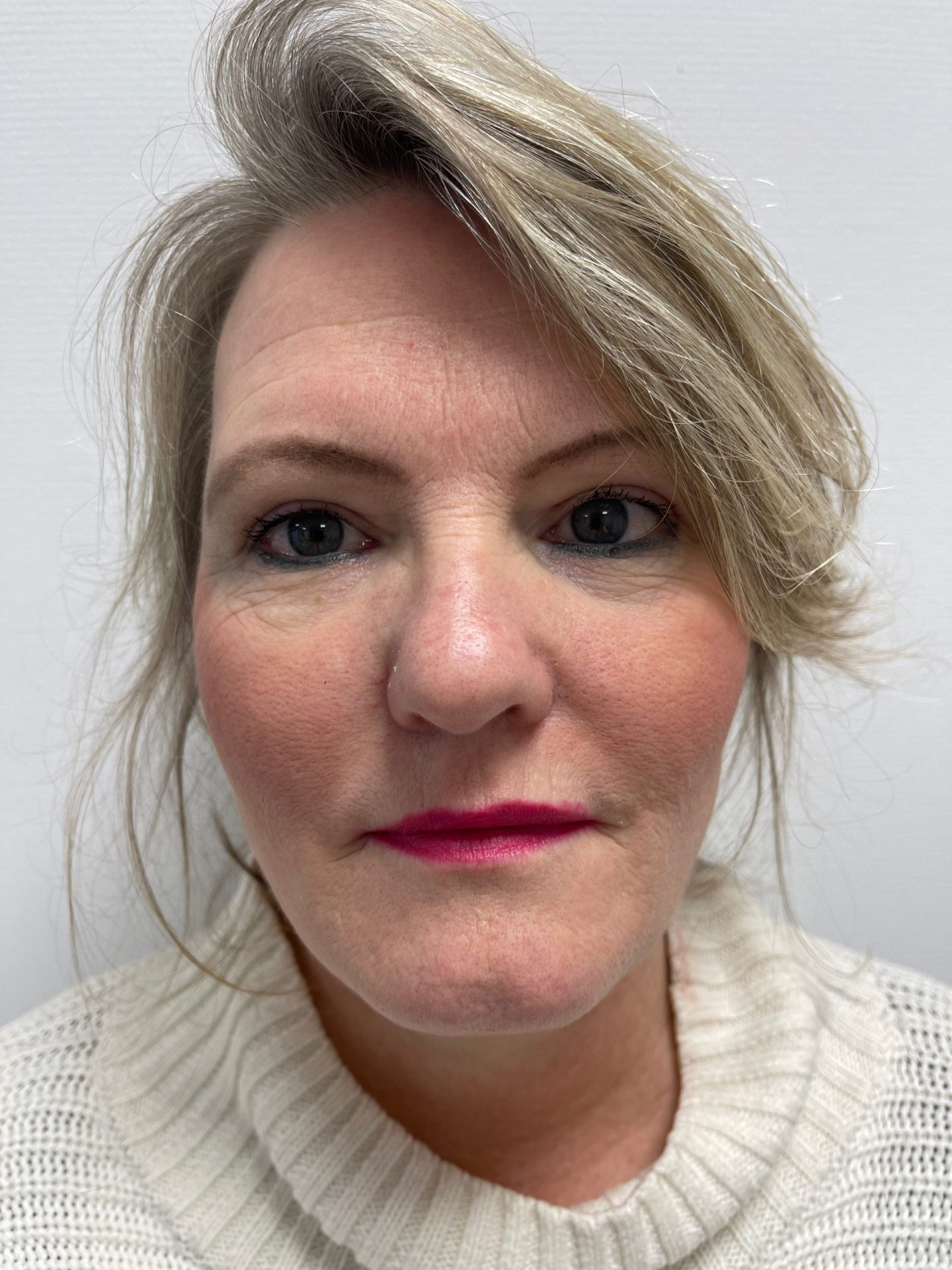 Eyelid correction after