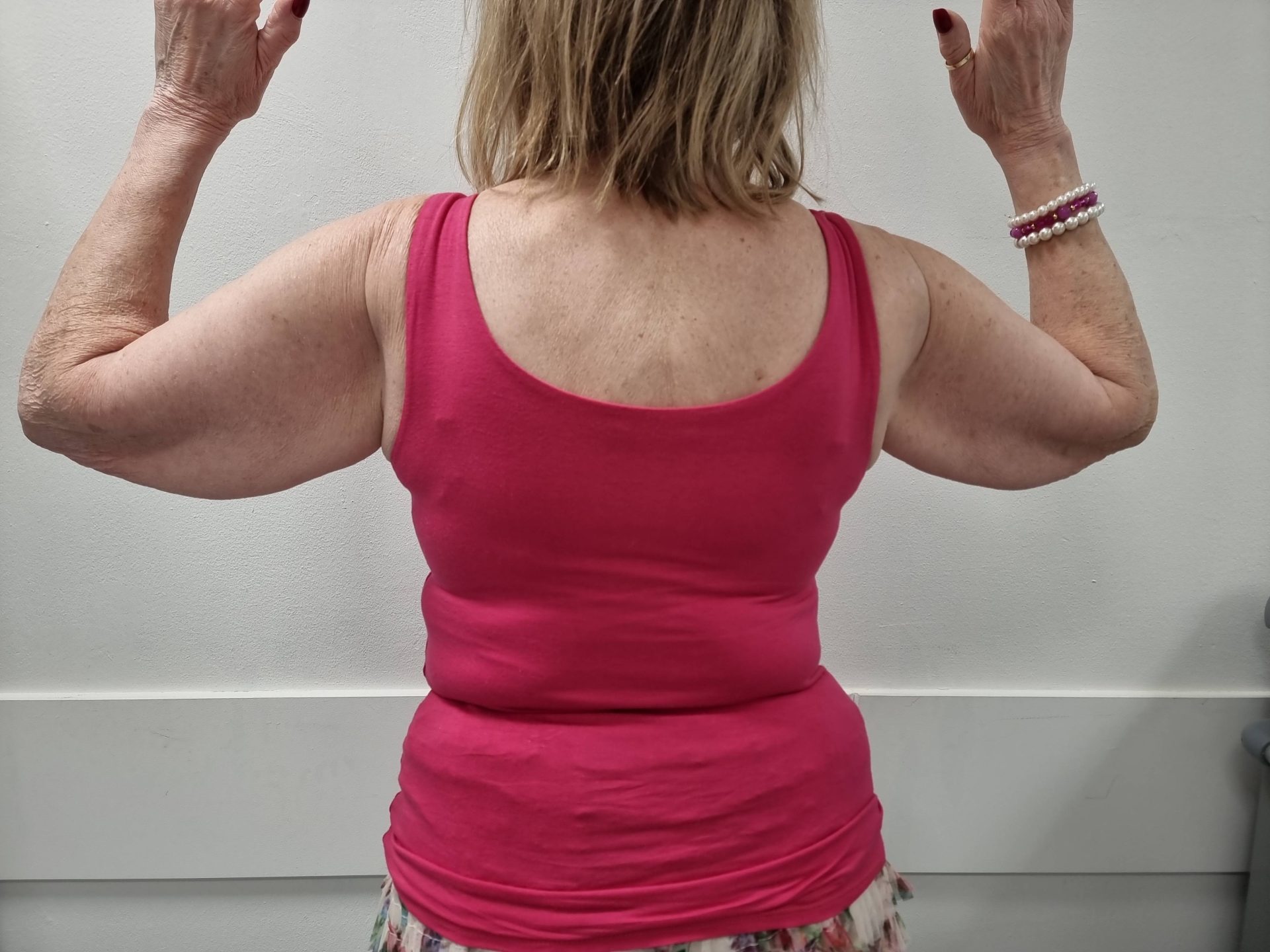 Armlift before