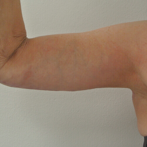 Armlift after