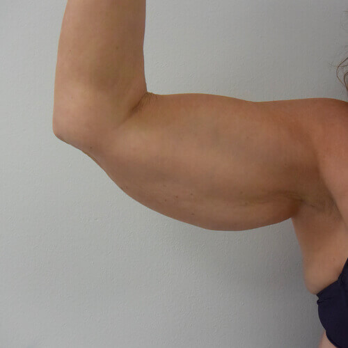 Armlift before