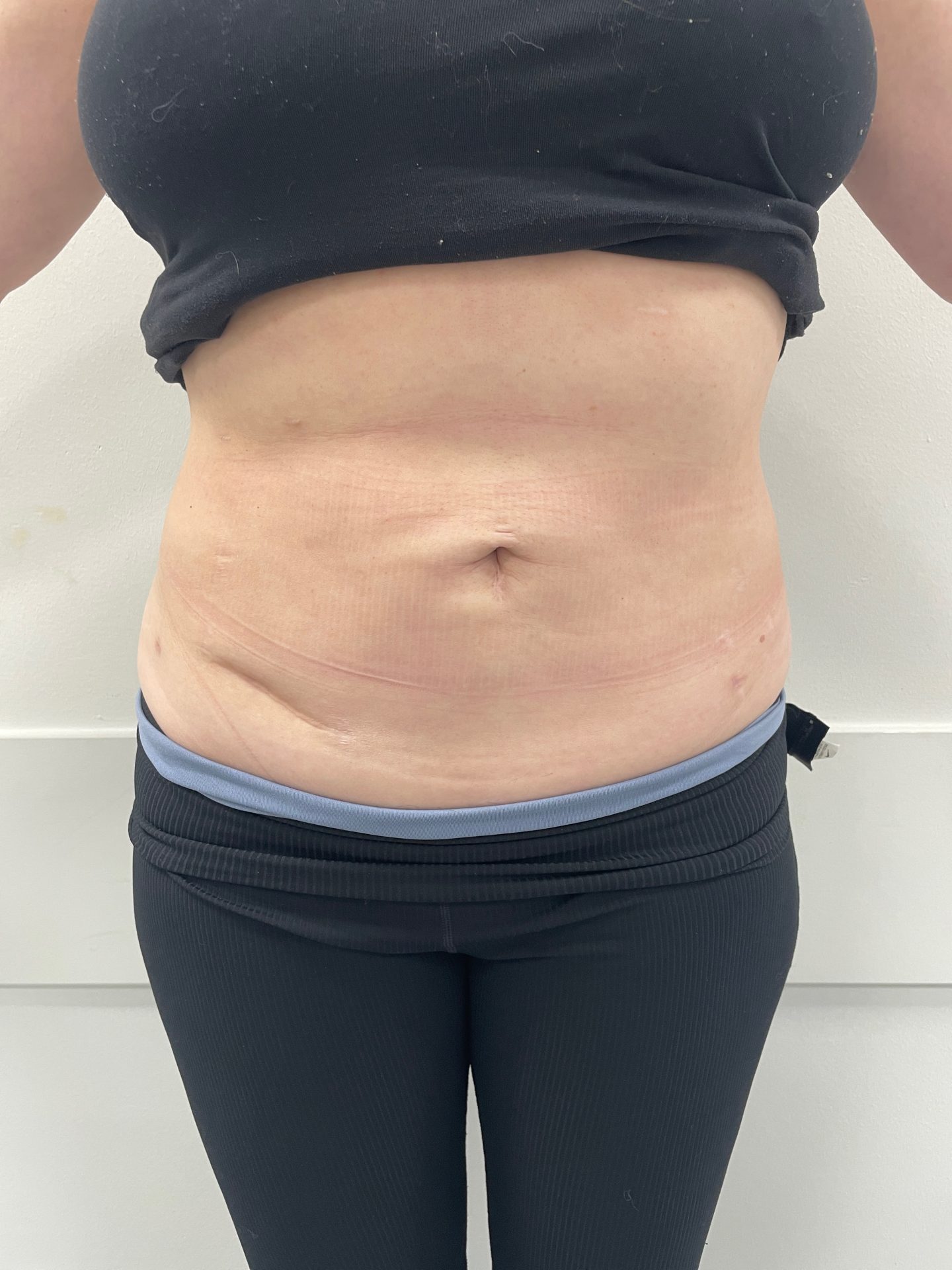 Liposuction after