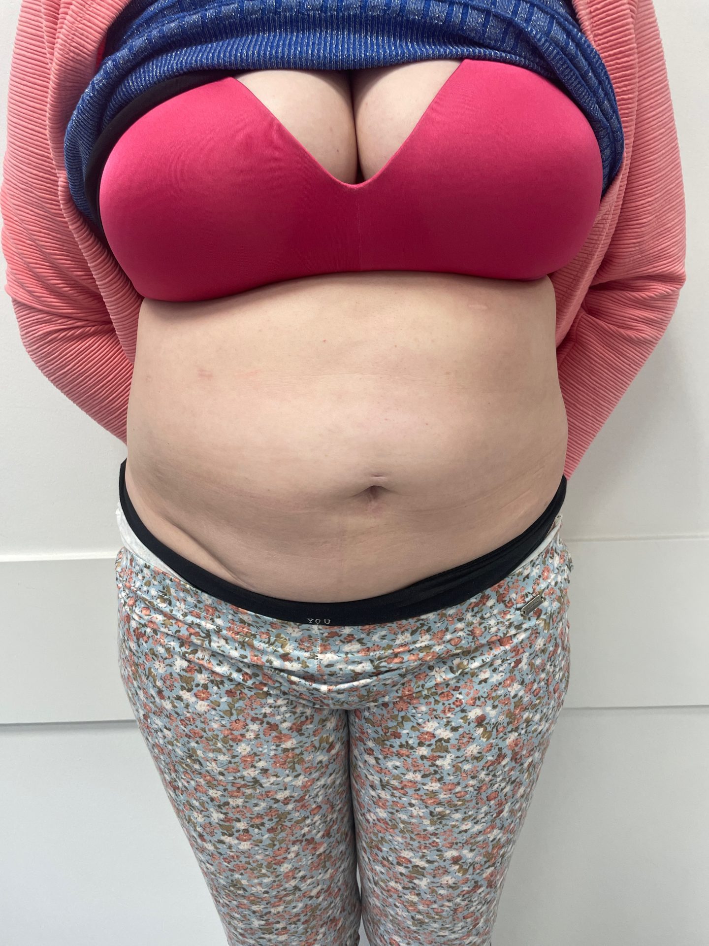 Liposuction before