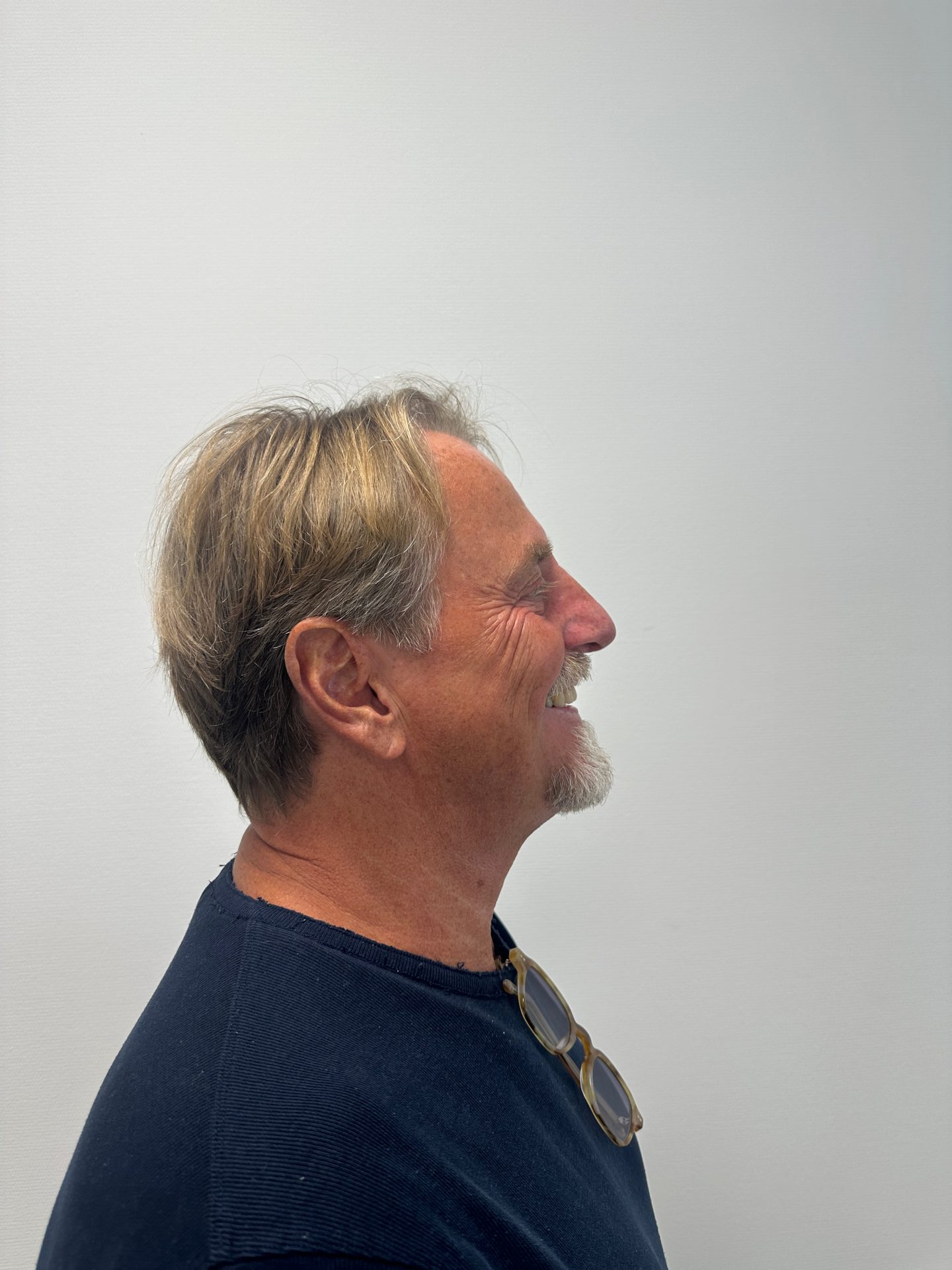 Nose correction after
