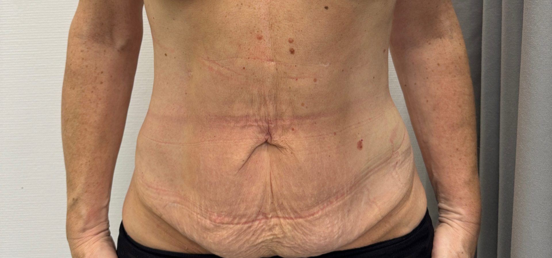 Tummy tuck before
