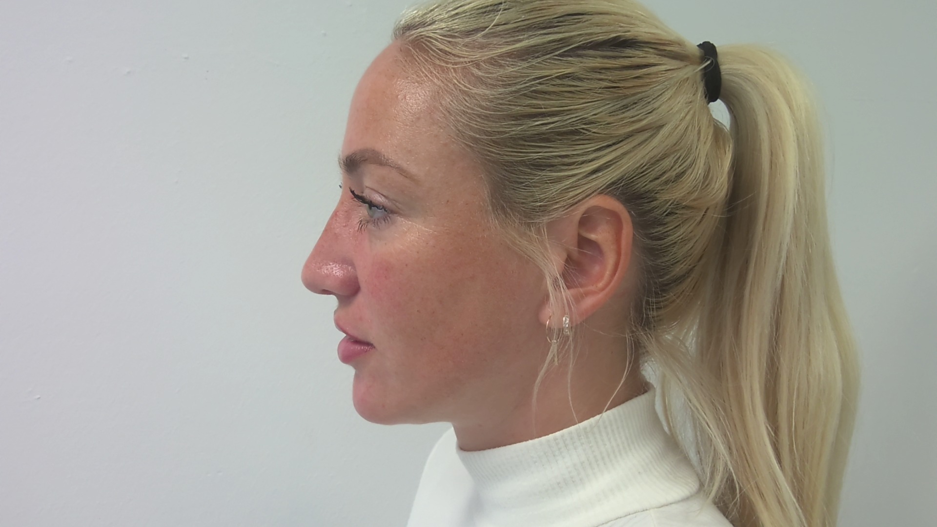 Nose correction after