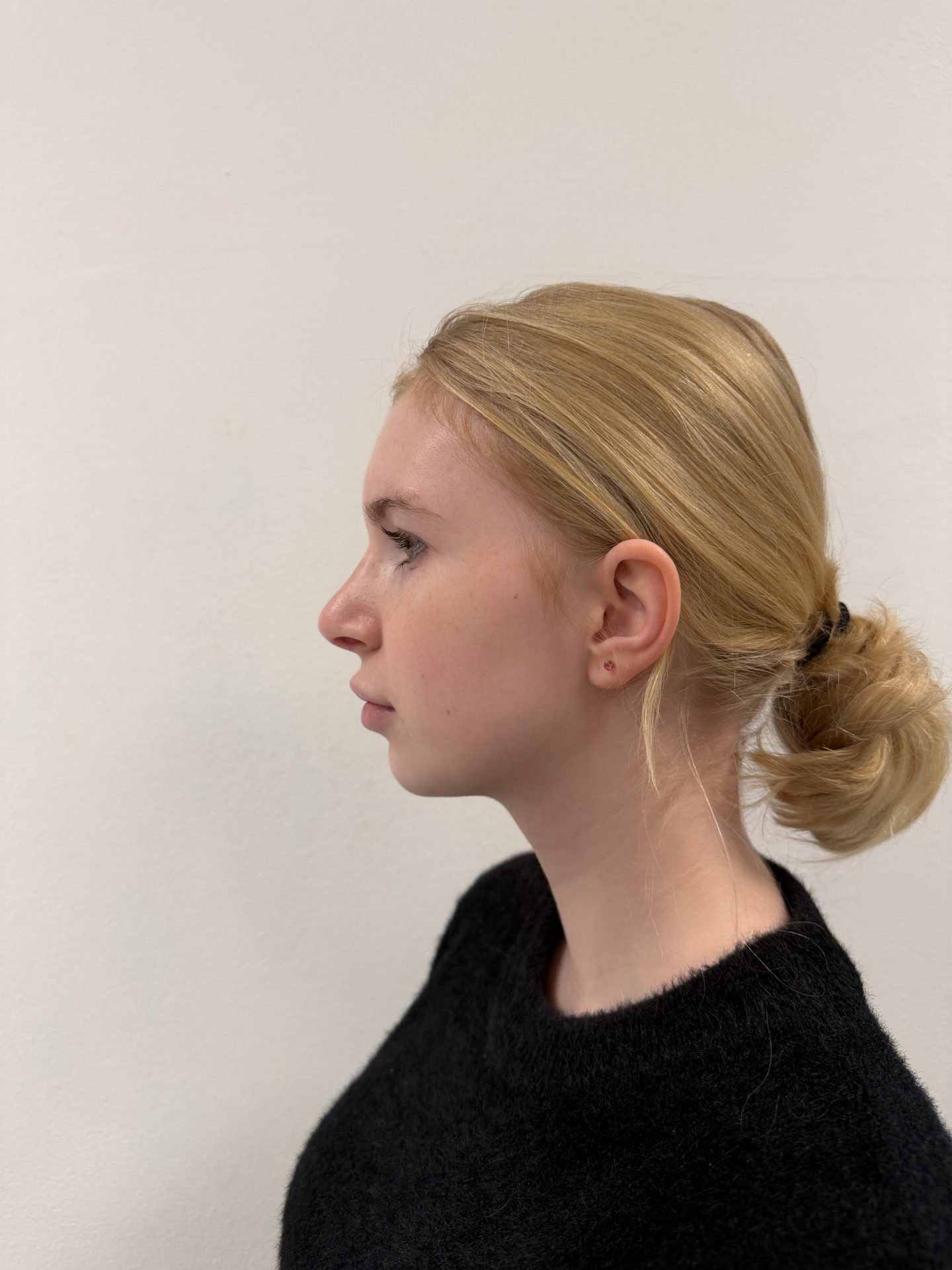 Nose correction after