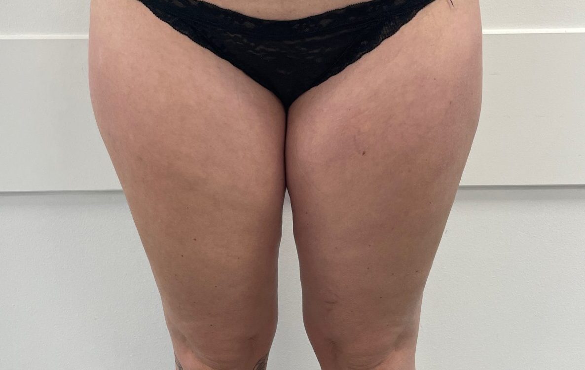Liposuction before