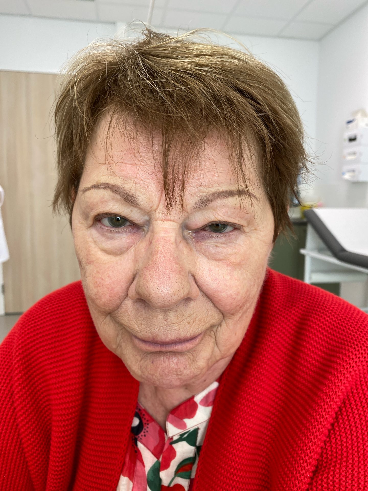 Eyelid correction before