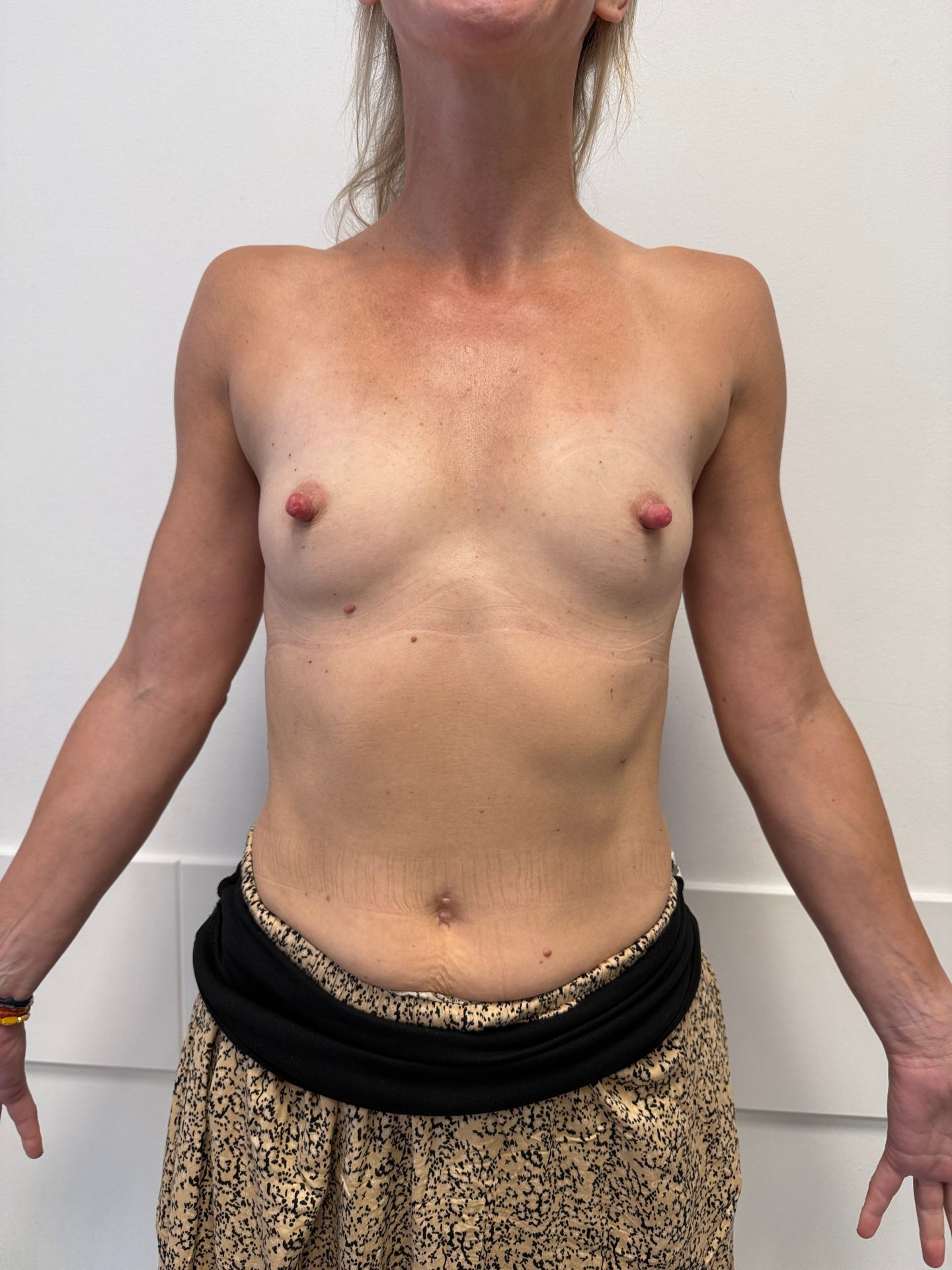 Breast augmentation before