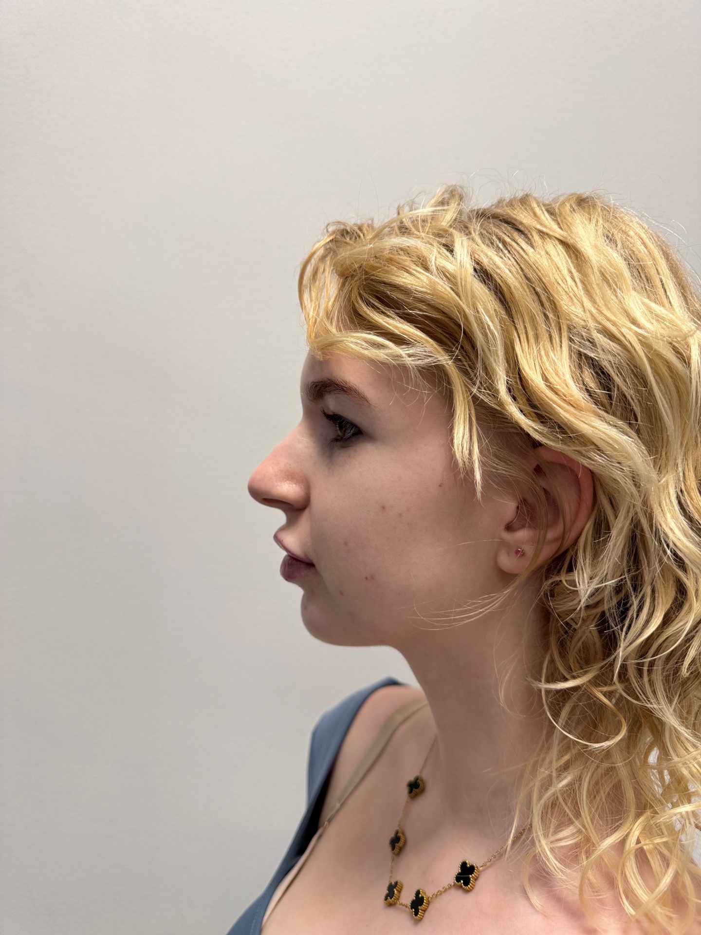 Nose correction before