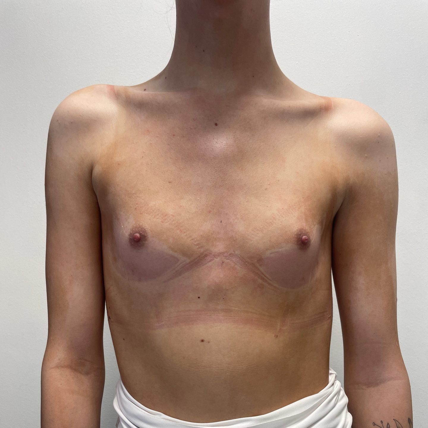 Breast augmentation before