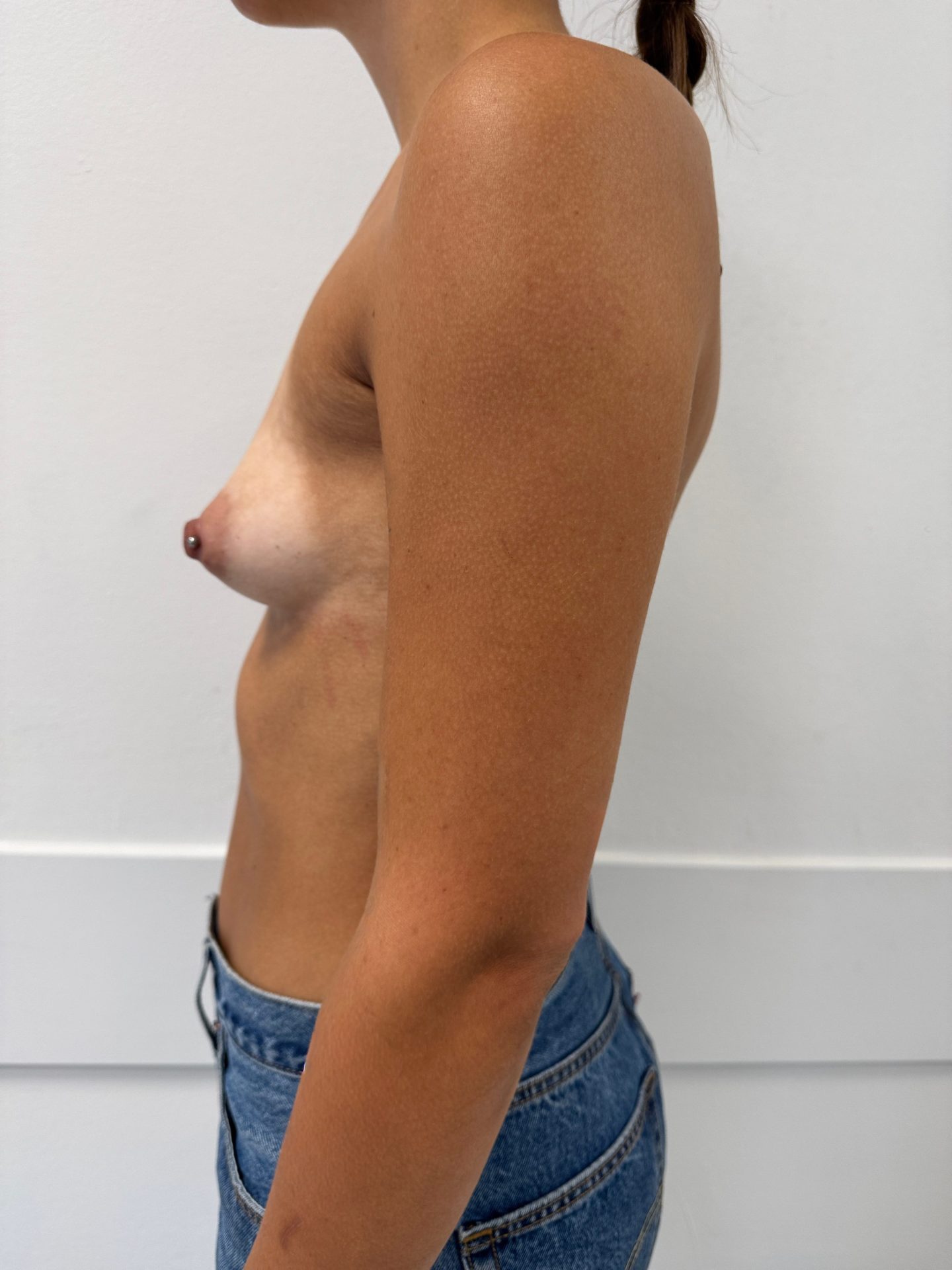 Breast augmentation before