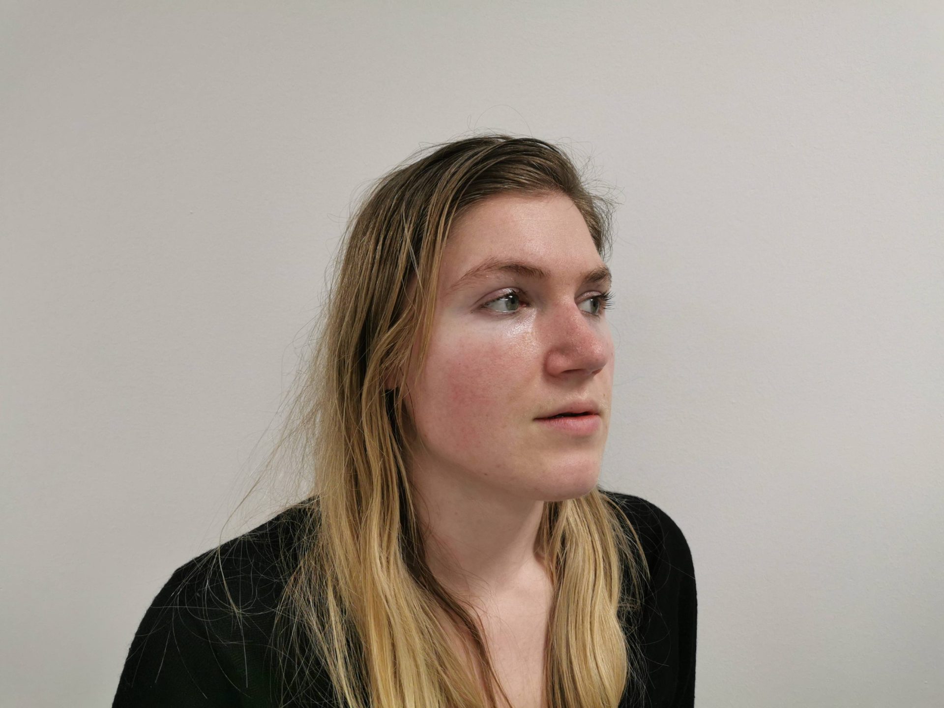 Nose correction after