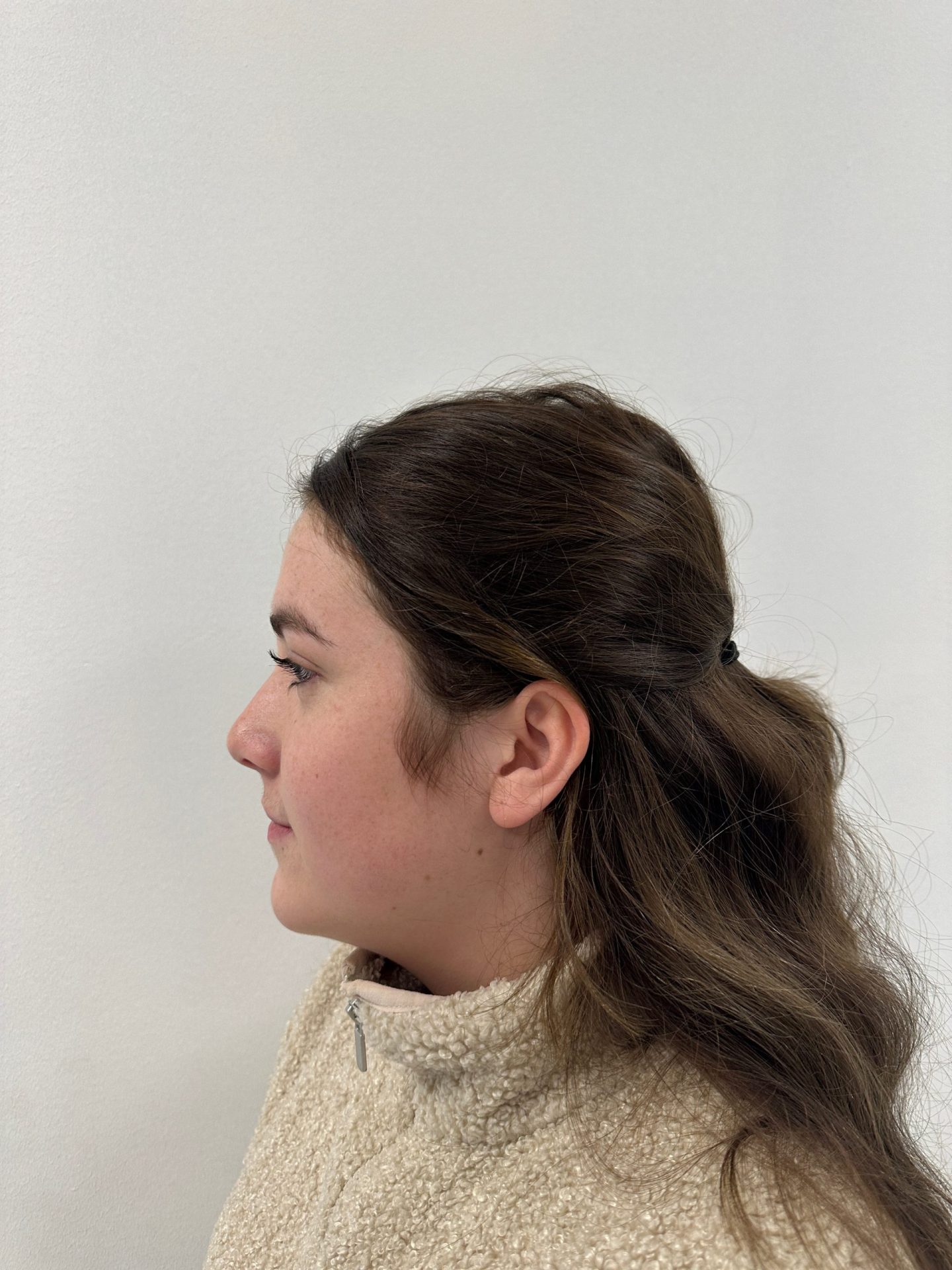 Nose correction after