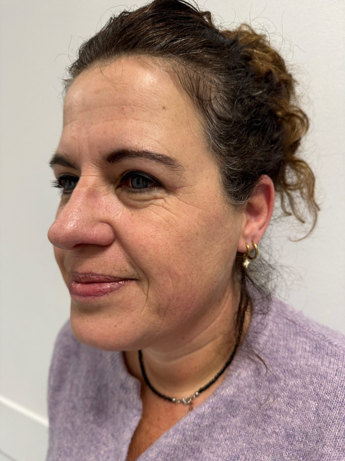 Eyelid correction after