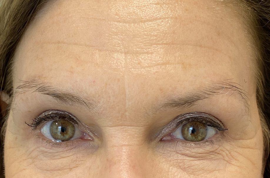 Eyebrow lift after