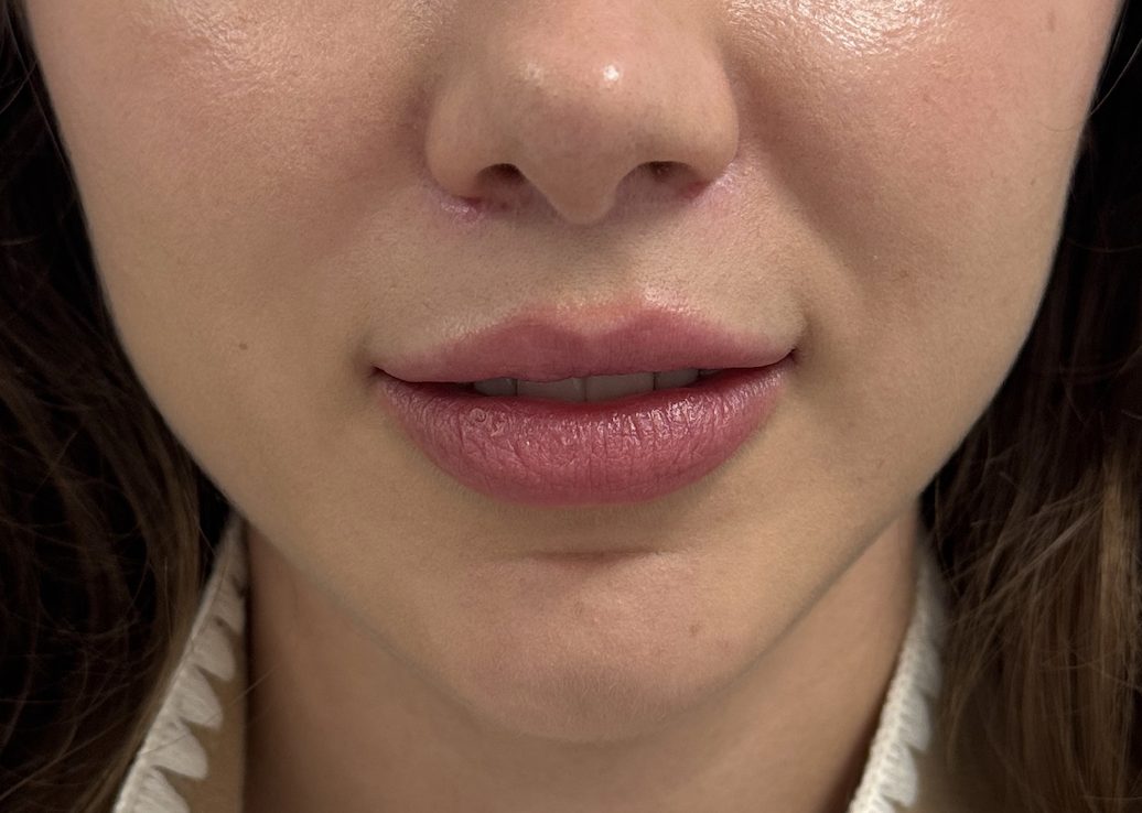 Lip correction after