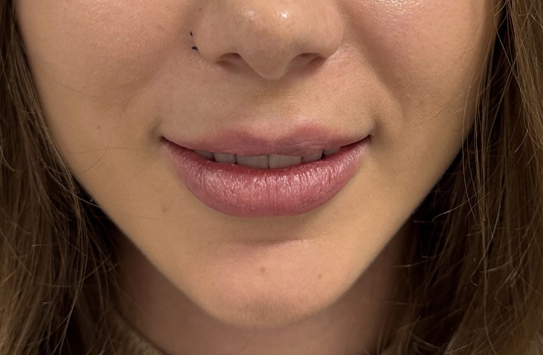Lip correction before