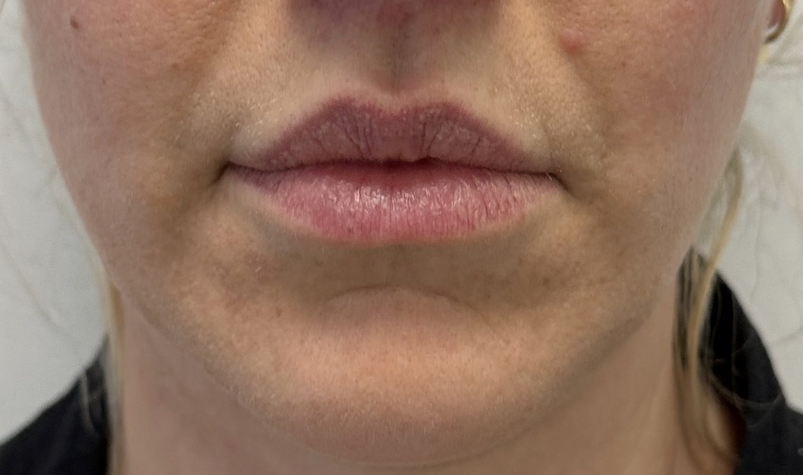Lip correction after