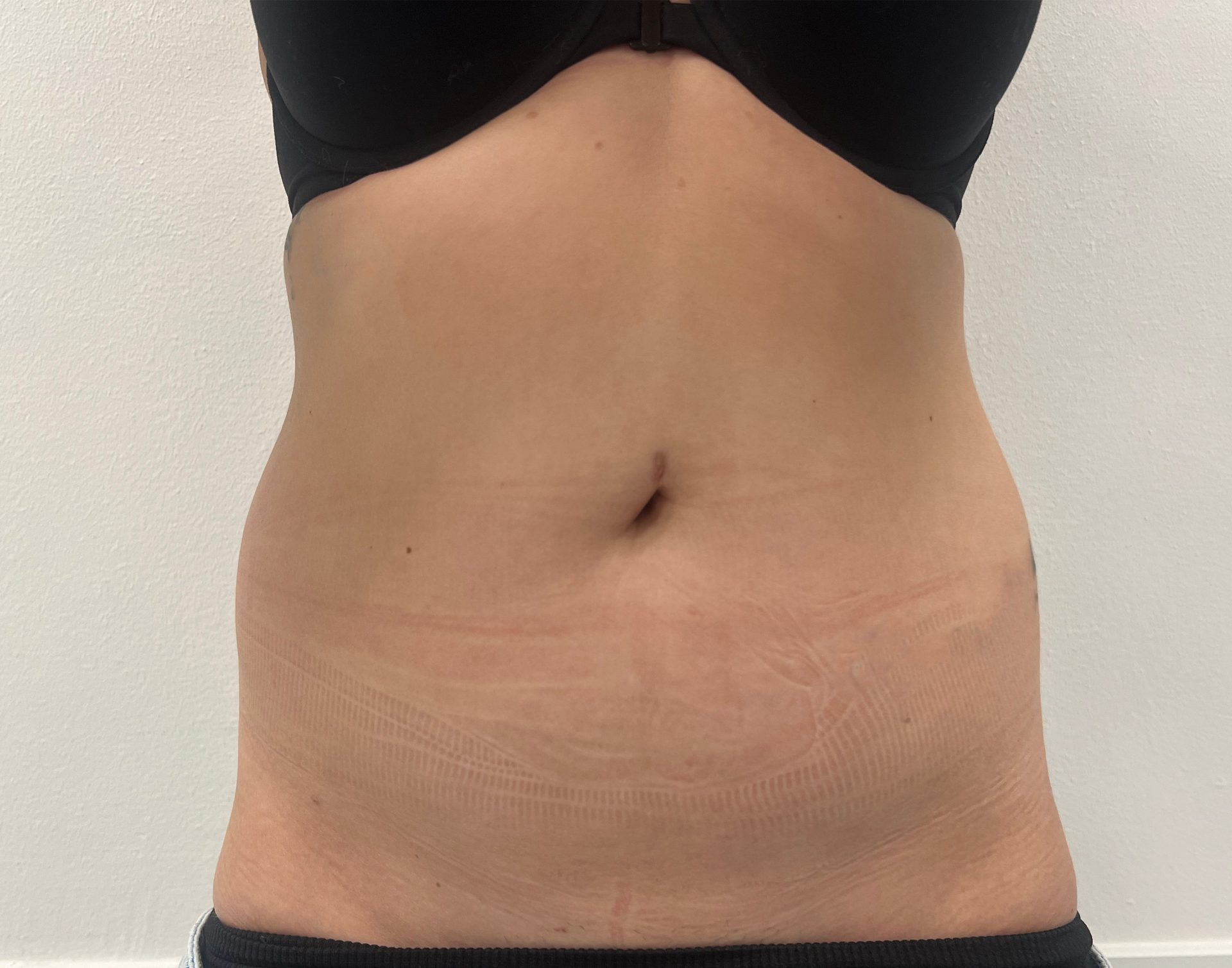 Liposuction before