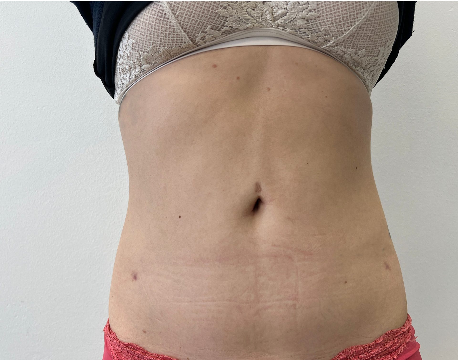 Liposuction after
