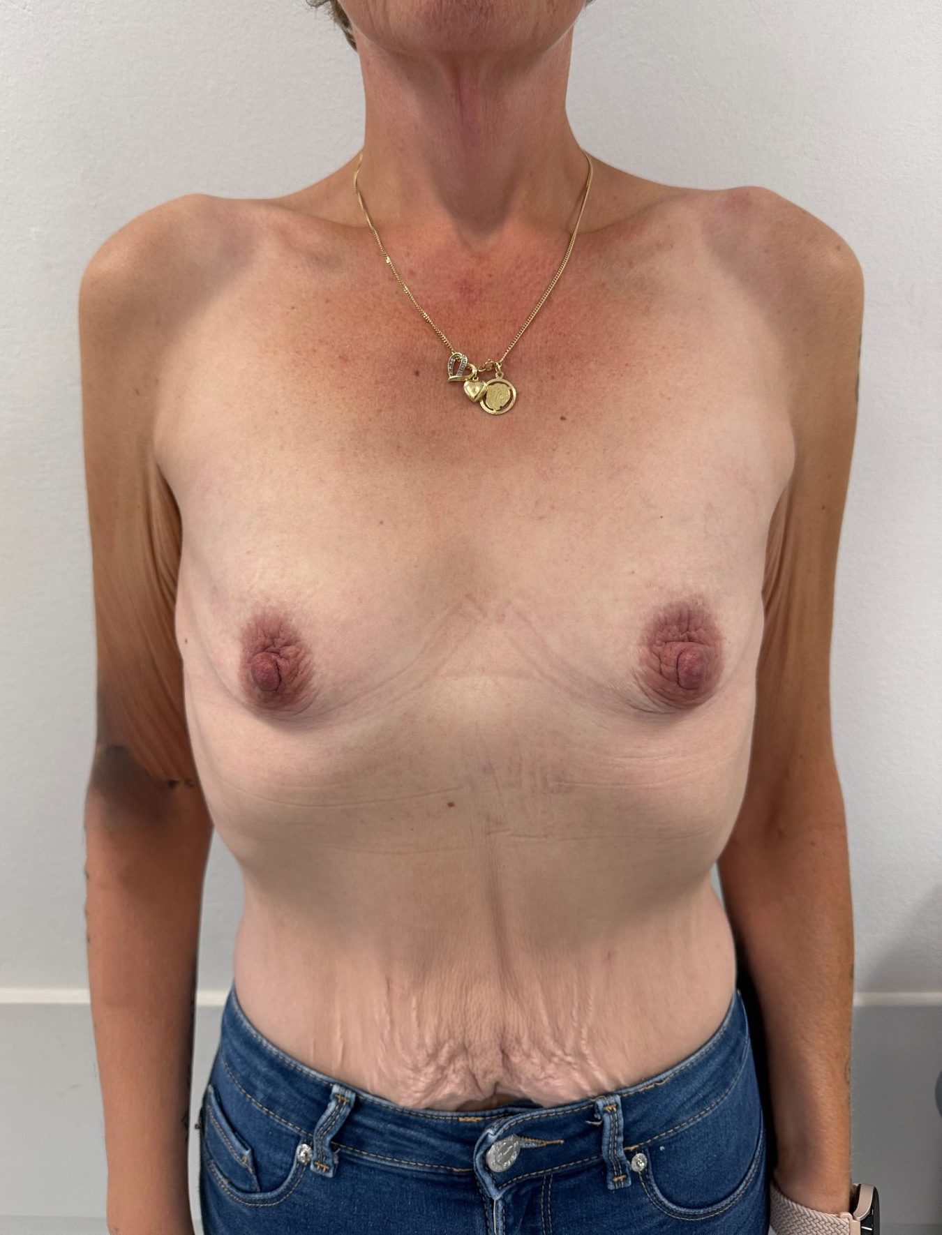 Breast augmentation before