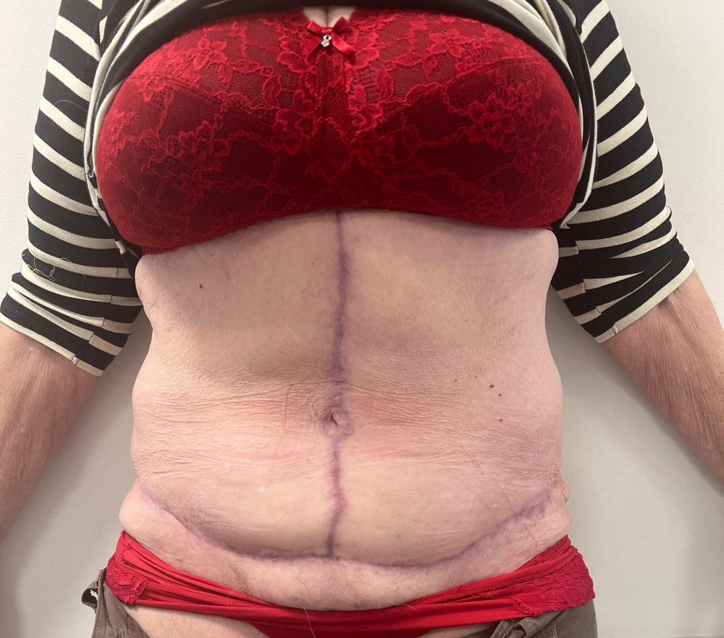 Tummy tuck after