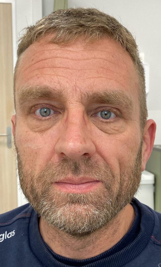 Eyelid correction after