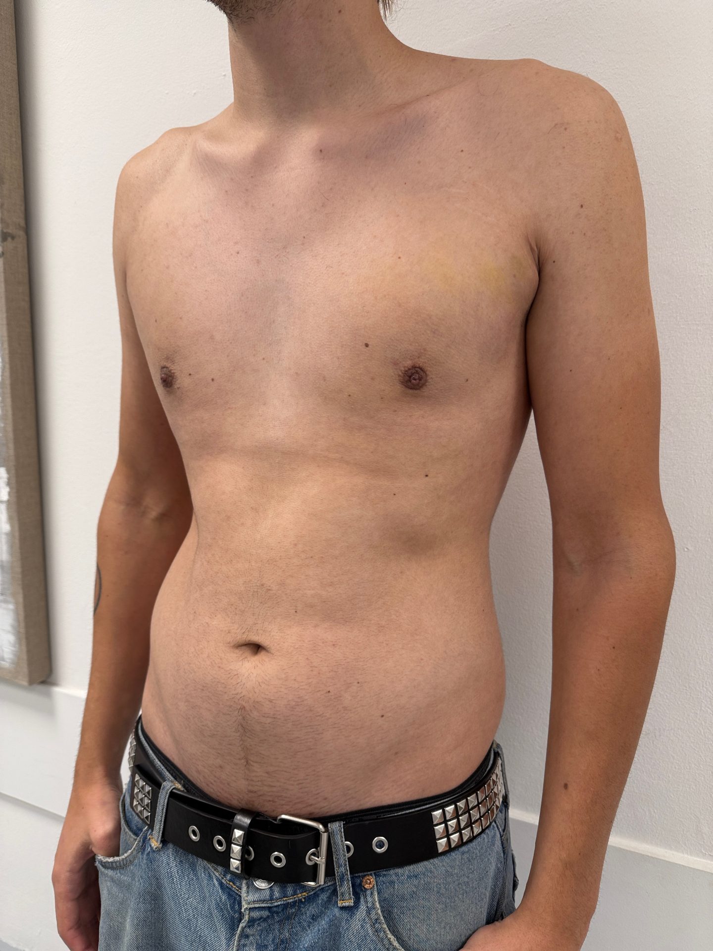 Breast correction for men after