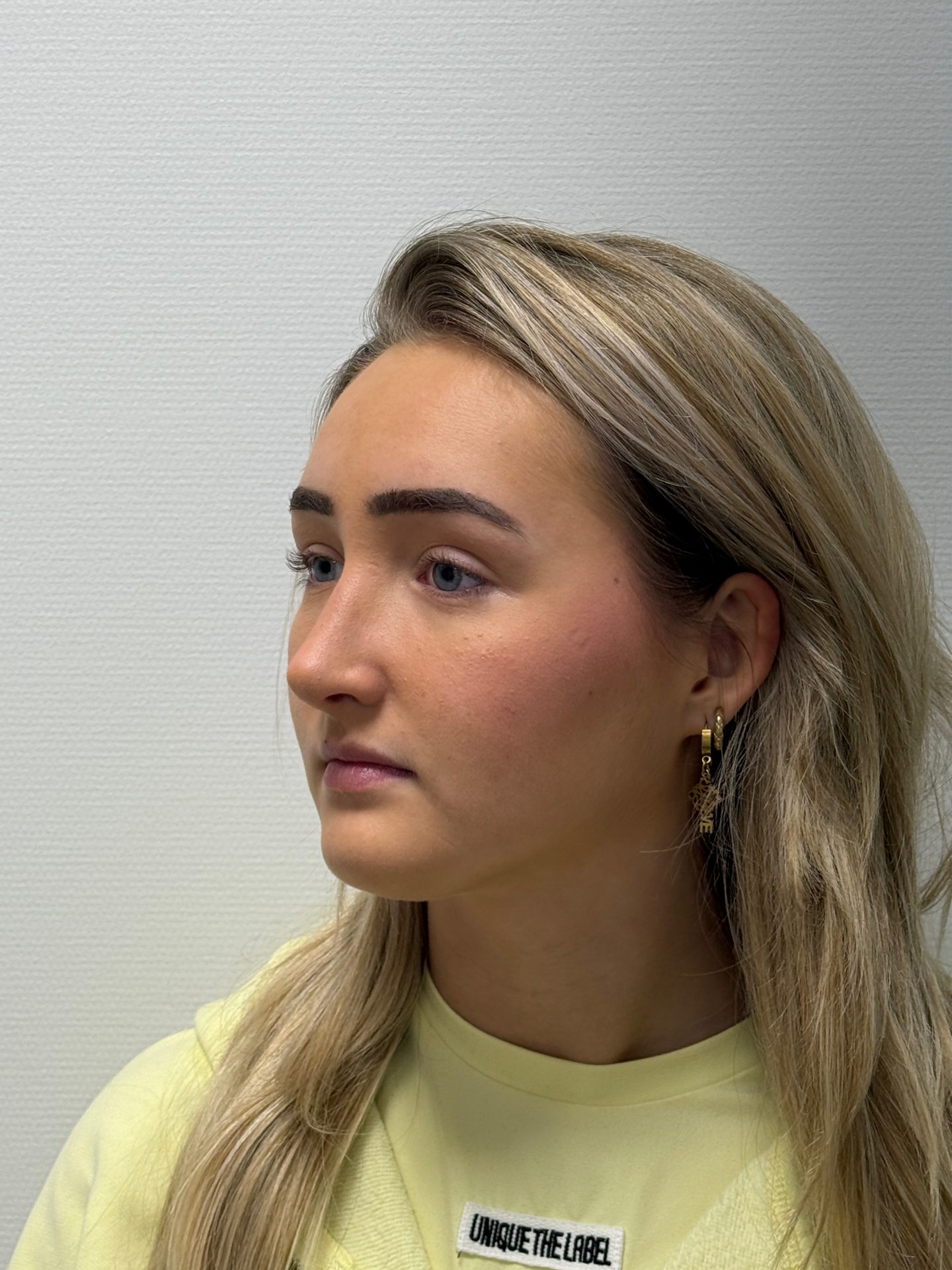 Nose correction after