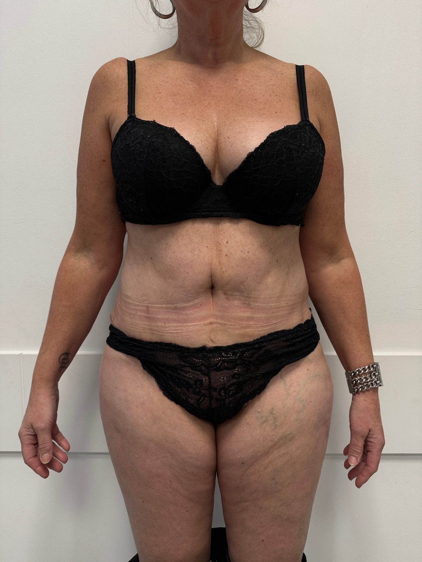 Tummy tuck after