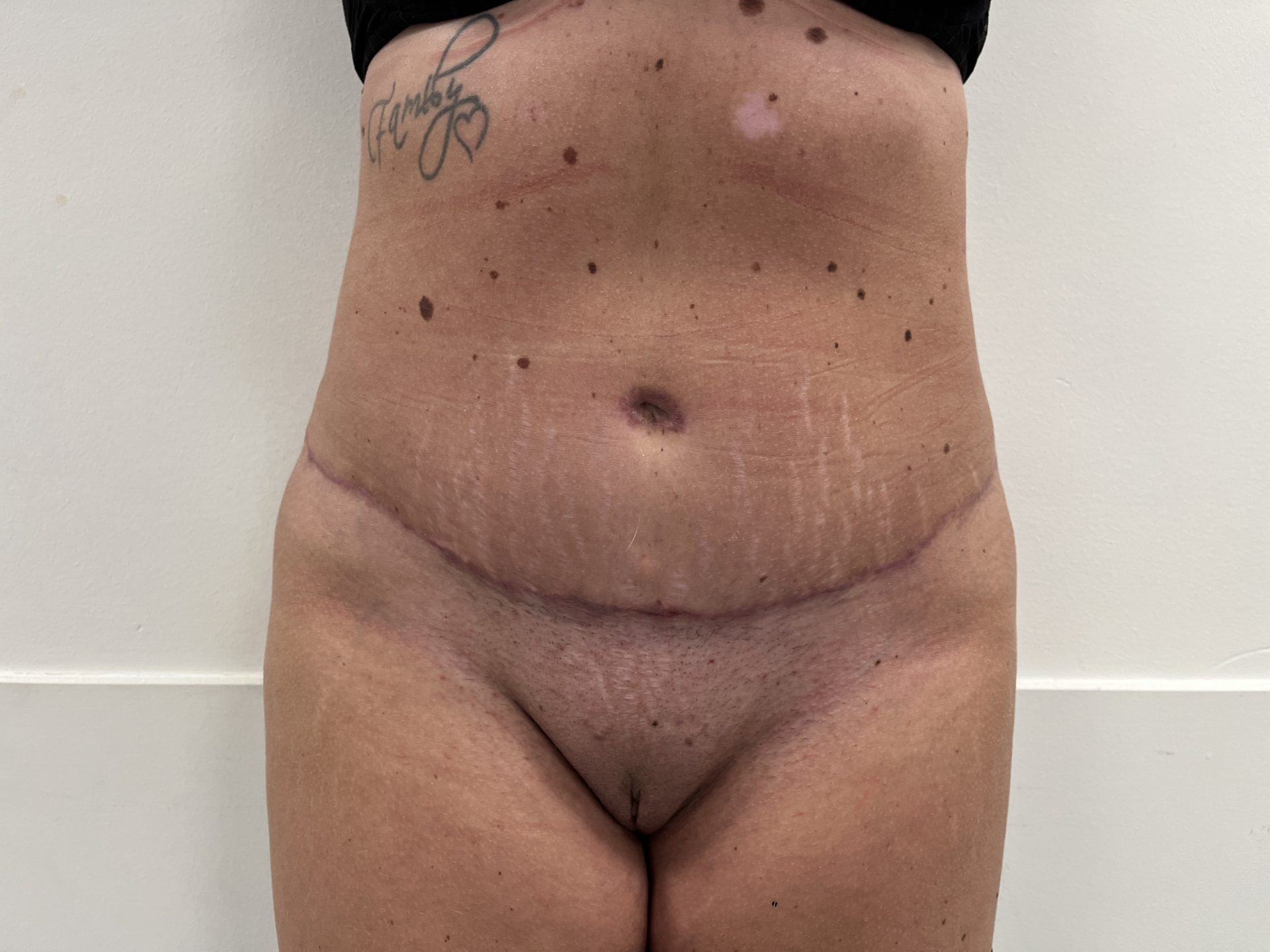 Tummy tuck after