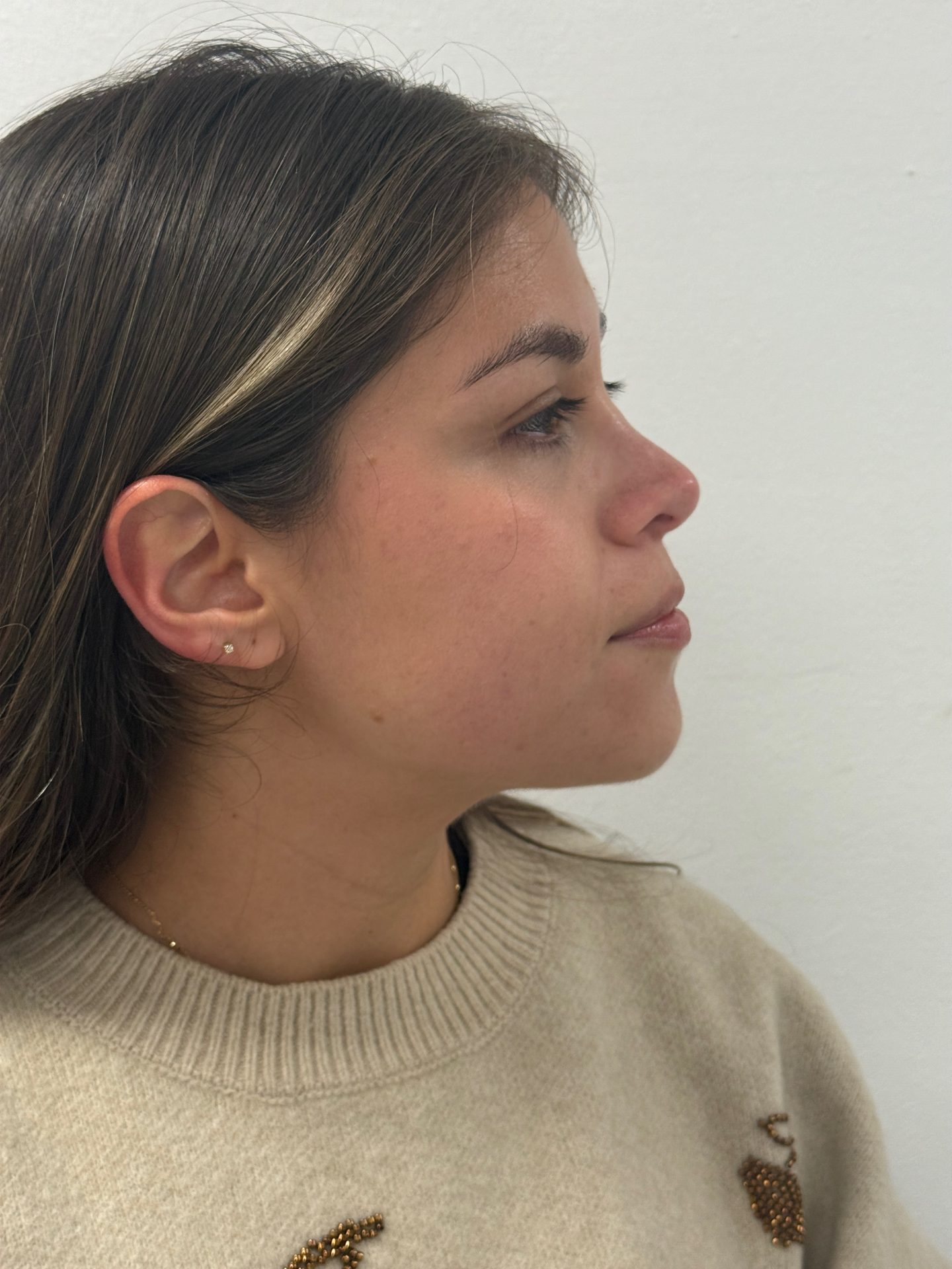 Nose correction after