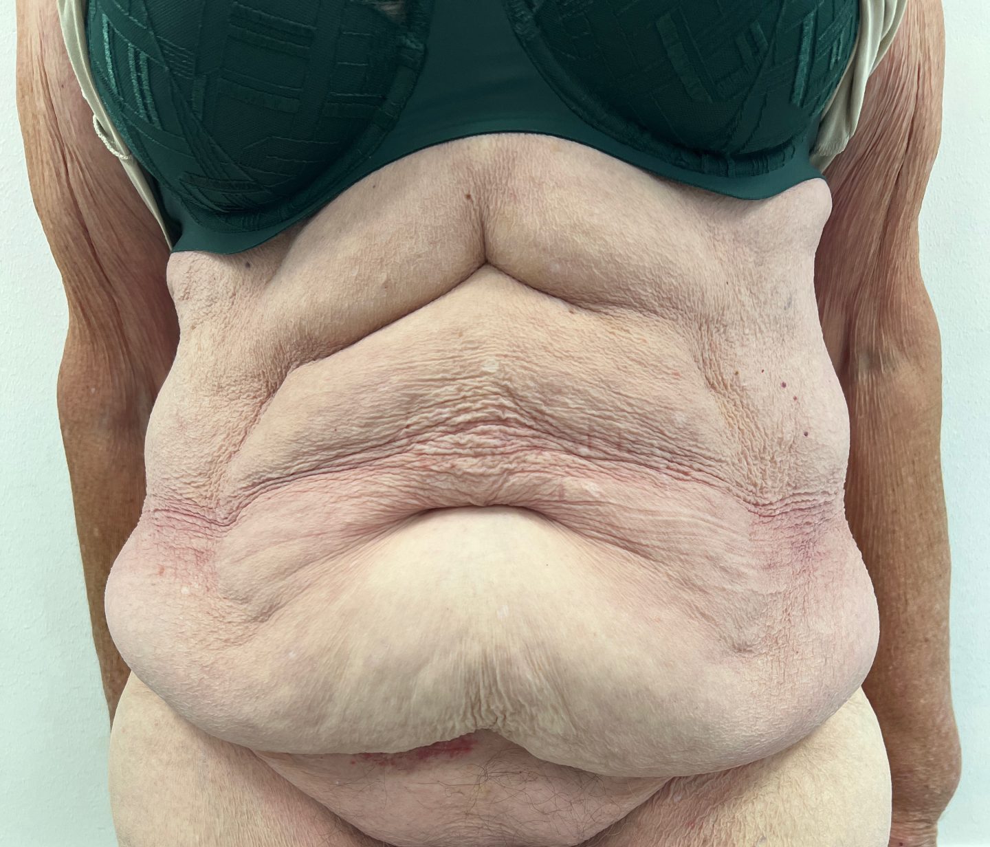Tummy tuck before