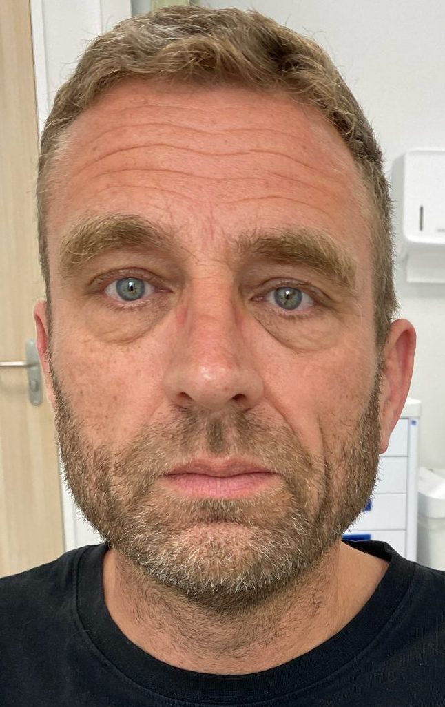 Eyelid correction before