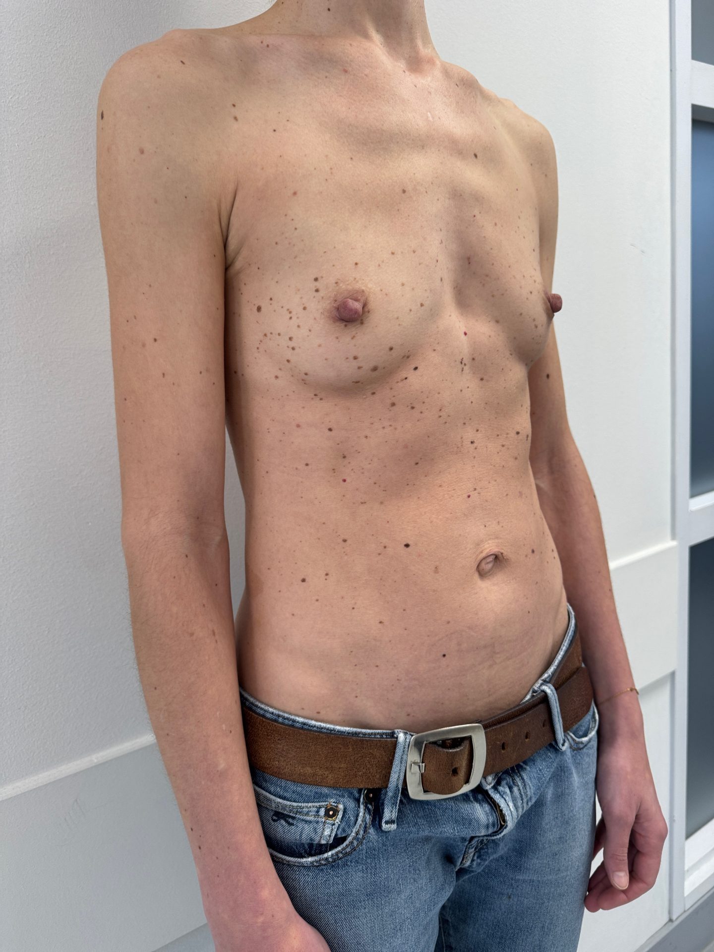 Breast augmentation before