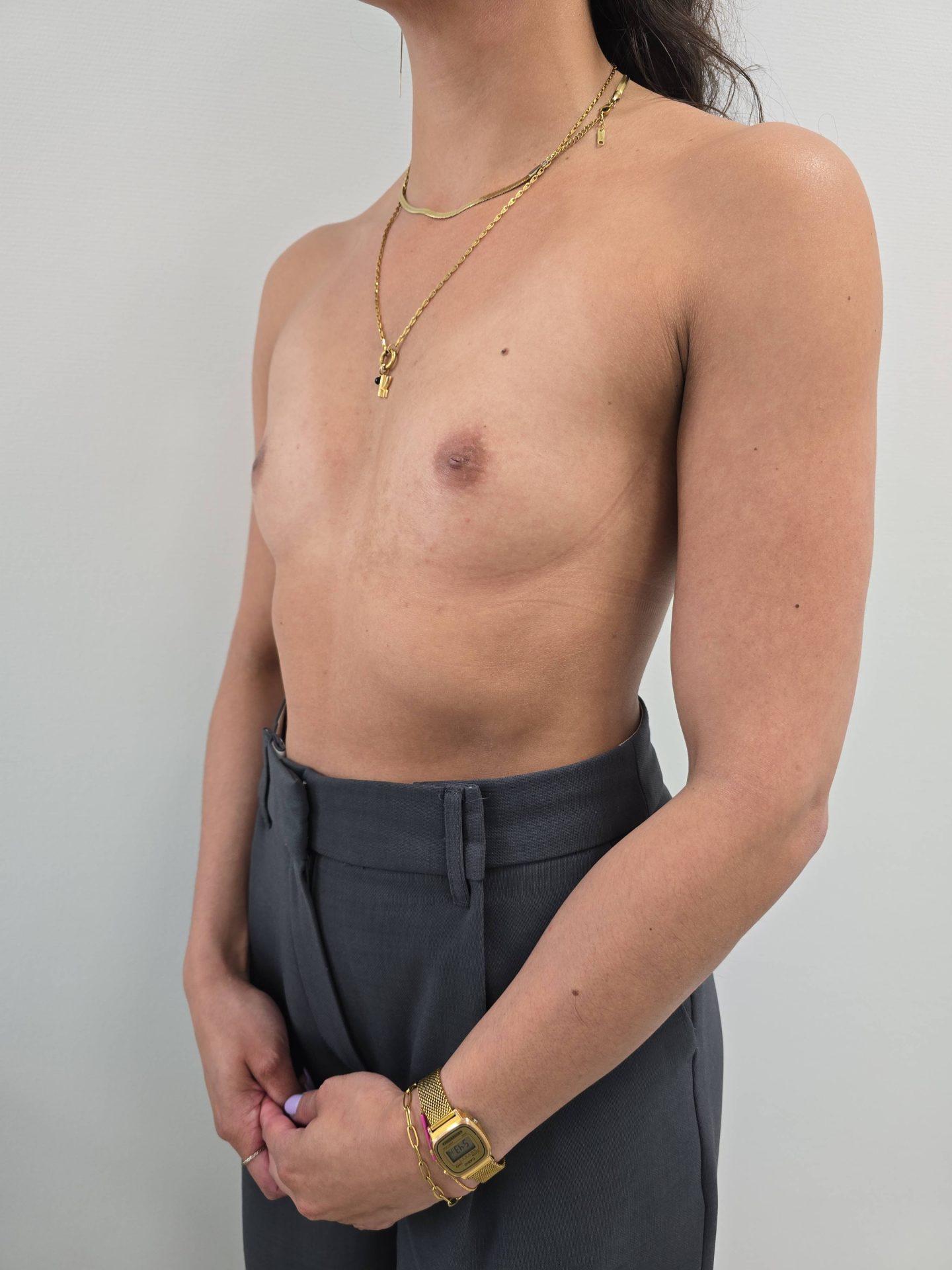 Breast augmentation before