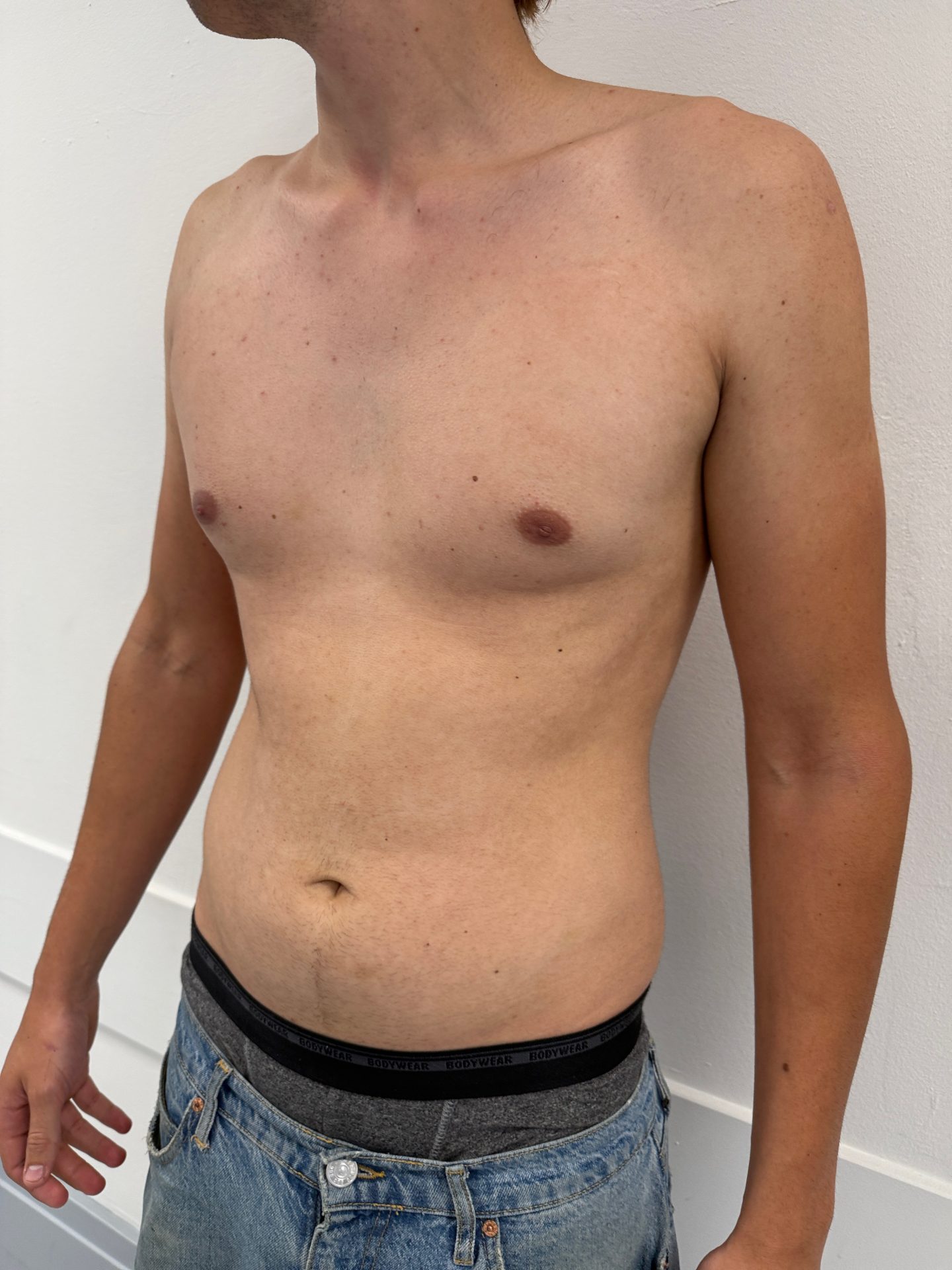 Breast correction for men before