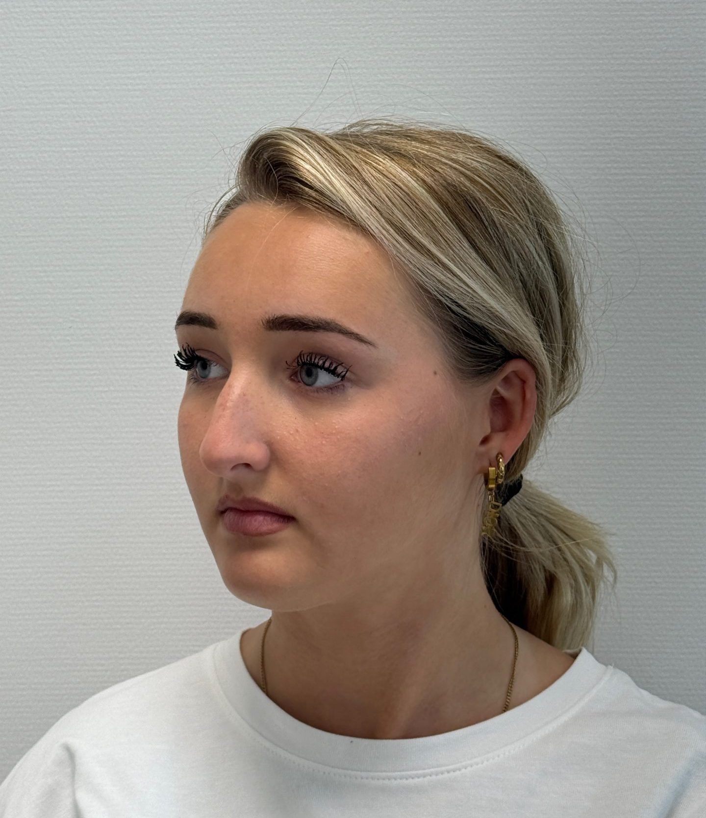 Nose correction before