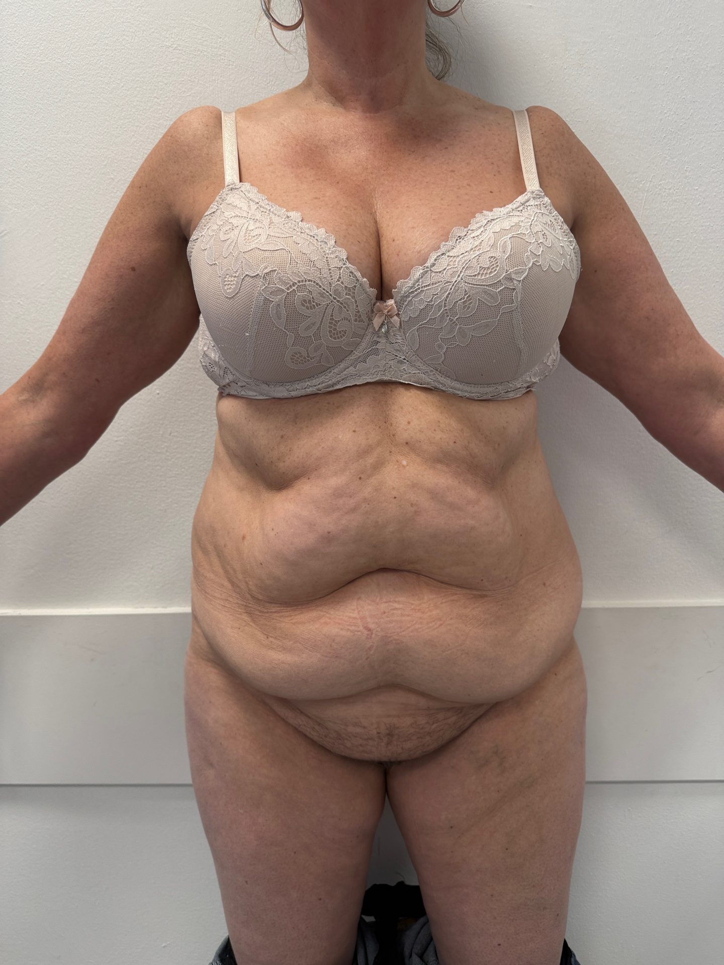 Tummy tuck before